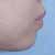 顎の整形講座　症例写真